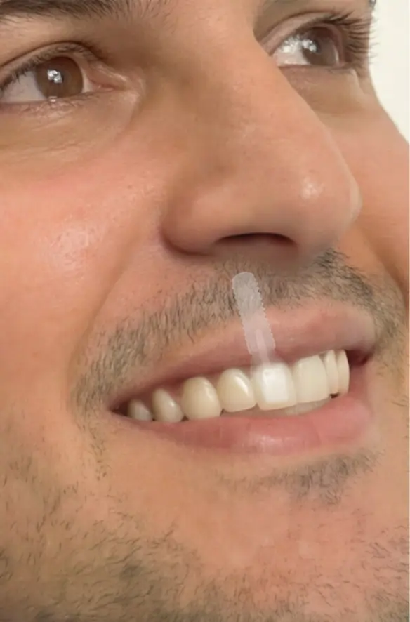 Implantología estética y planificación digital por etapas