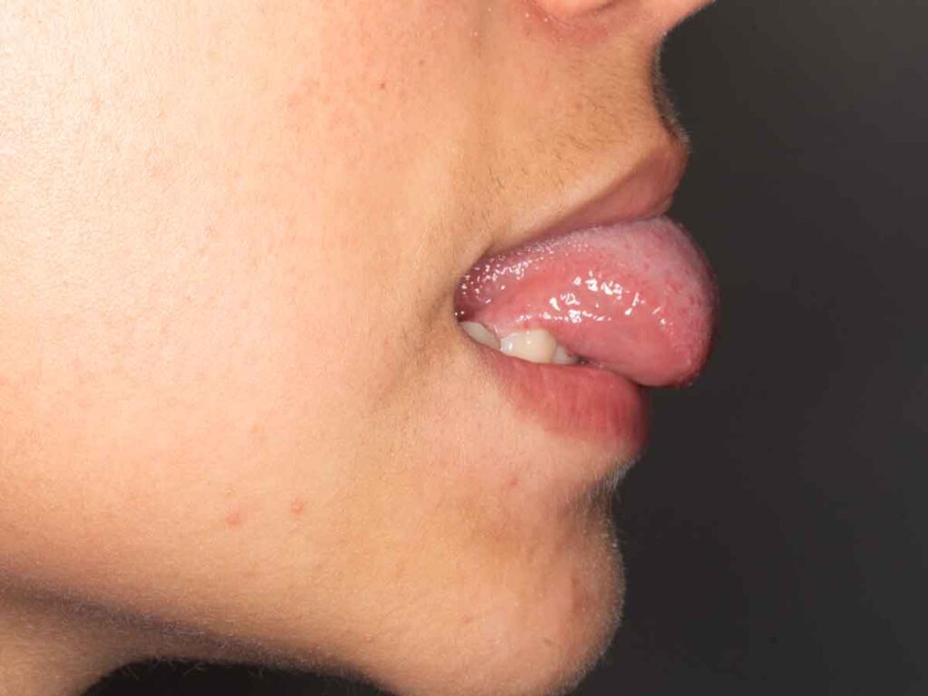 Postoperatorio 7 días de resección frenillo lengua, sin dolor y recuperación 100% motilidad lingual