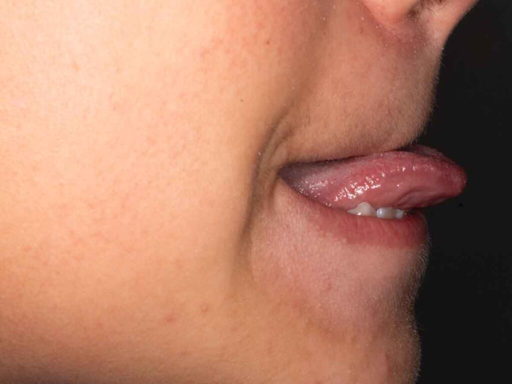 Postoperatorio 7 días de resección frenillo lengua, sin dolor y recuperación 100% motilidad lingual