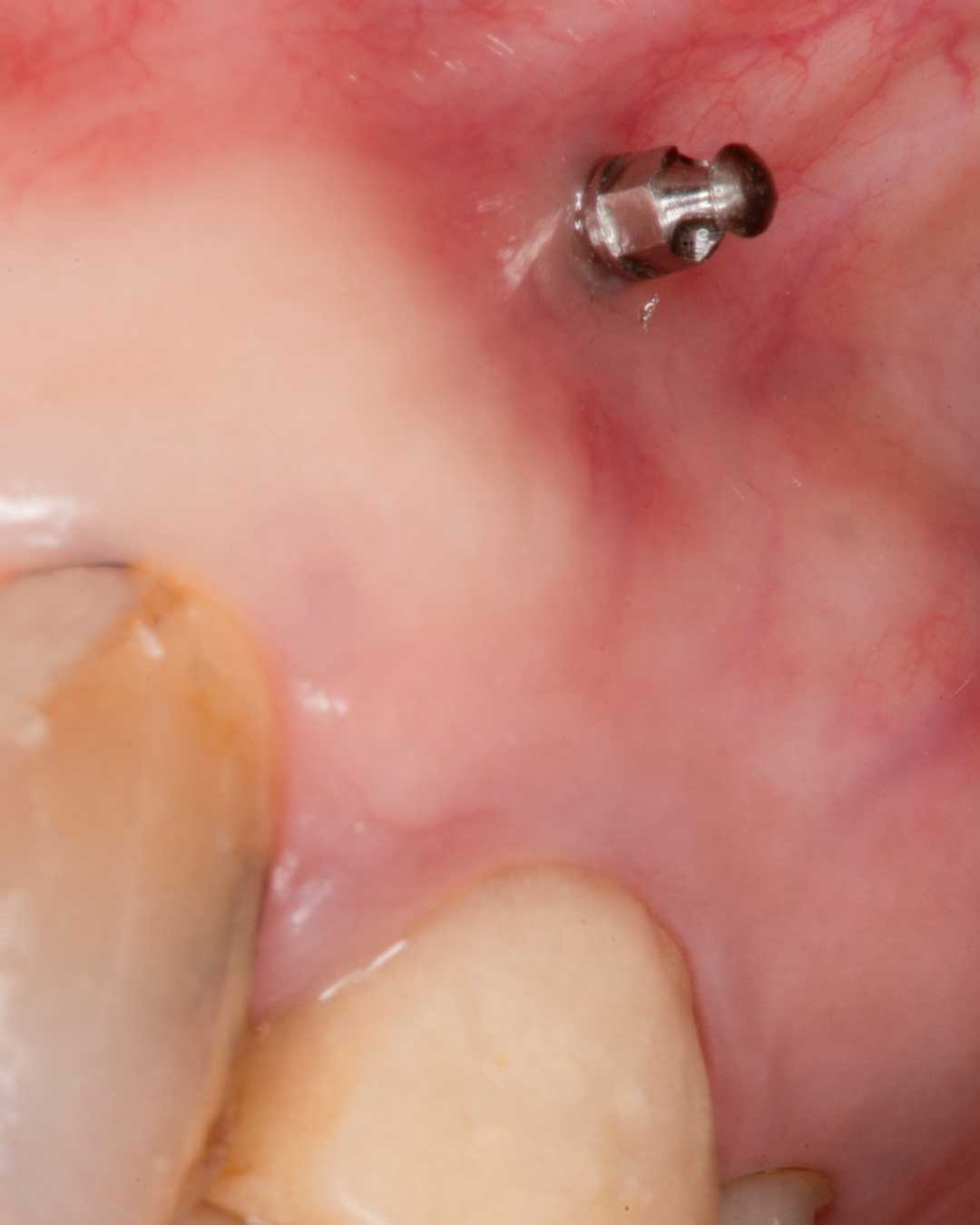 Mini implante ortodoncia