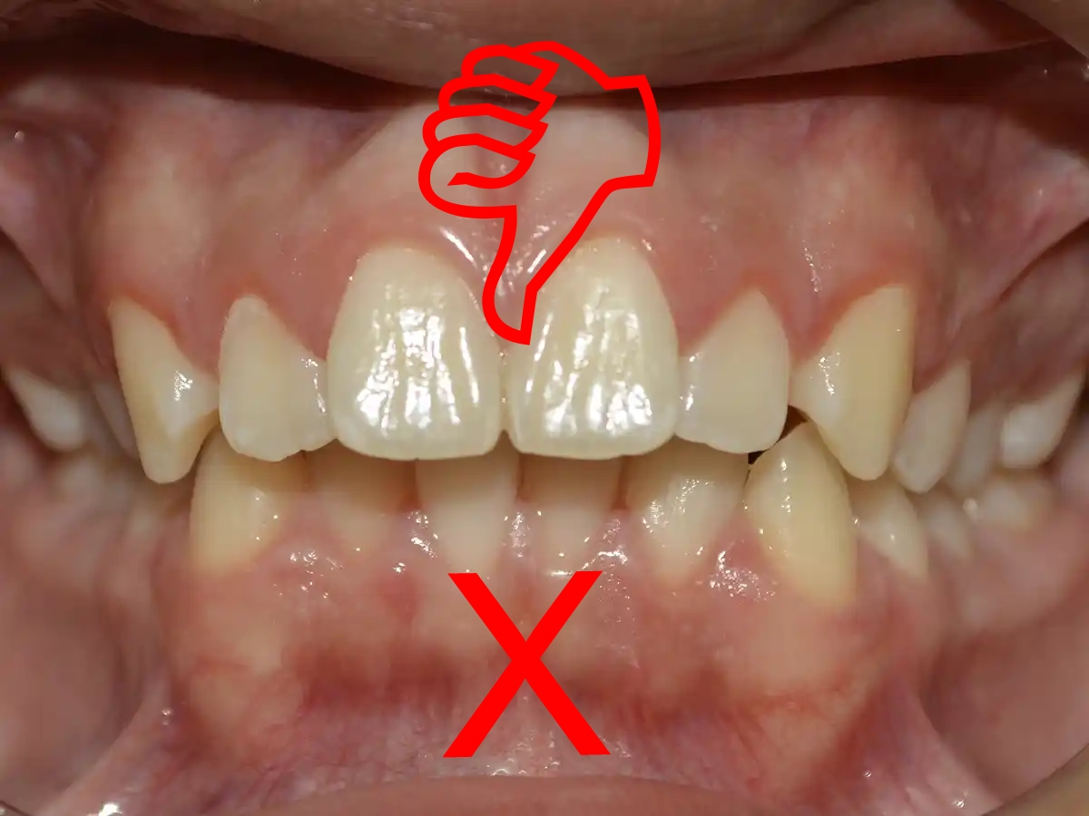 Alteracion en desarrollo de maxilares