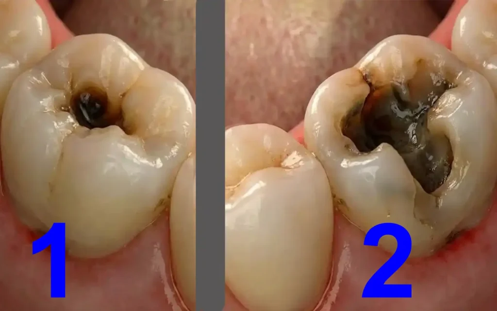 Caries dental incipiente Vs caries dental profunda