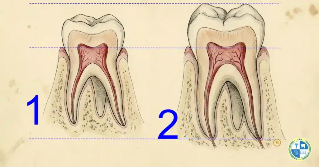 1 molar temporal, 2 Molar permanente. Extracción dental