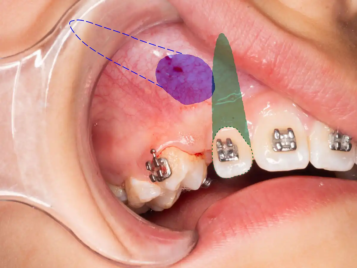 Esquema clínico de canino retenido y trayectoria eruptiva alterada