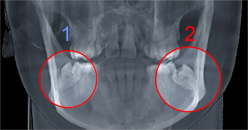 dolor de muelas por pericoronaritis del tercer molar radiografía